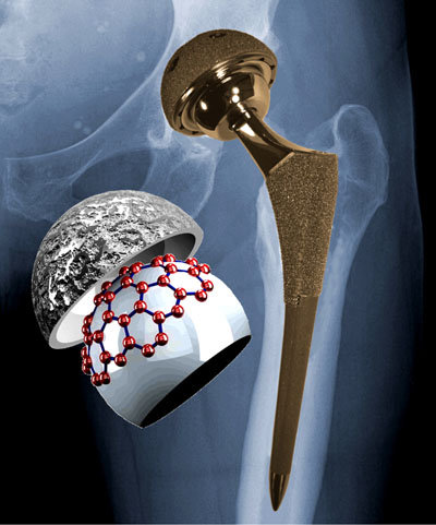 Hip implant